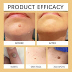 Timilk Wart & Mole Removal Spray