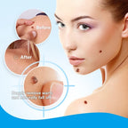 Timilk Wart & Mole Removal Spray