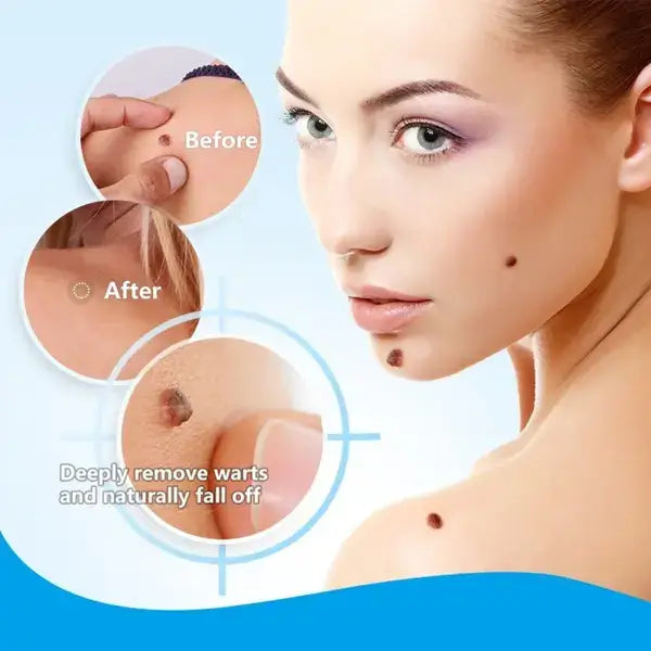 Timilk Wart & Mole Removal Spray