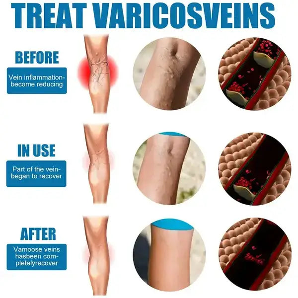 Varicose Veins Treatment Spray - Veins Relief Oil